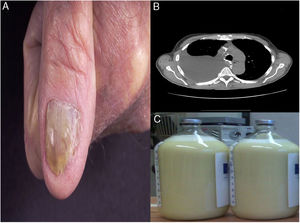 (A) Yellow dystrophic fingernails. (B) Computed Tomography of the chest demonstrated large right-sided pleural effusion. (C) Milky white “Chylous” pleural fluid.