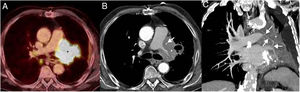 Axial fused PET/CT image (A) demonstrates a hypermetabolic mass (asterisk). Axial CT image (mediastinal window) from the CT portion of the PET/CT (B) study shows an increase in the size of the left hilar mass (asterisk) and a greater secondary encasement of the left internal mammary artery graft (arrow) with respect to the previous imaging study. Coronal CT image (mediastinal window) from the CT portion of the PET/CT (C) better depicts the encasement of the coronary artery bypass graft (arrows) by the mass (asterisk).