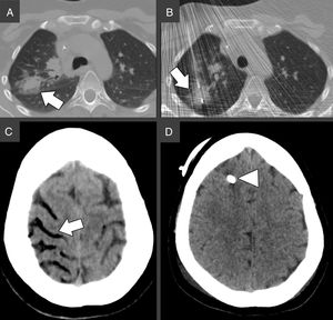 (A) Chest CT prior biopsy. The white arrow indicates the target lesion in the right upper lobe, in close proximity to the main fissure. (B) Chest CT during the biopsy. An 18-gauge Tru-Cut needle is successfully advanced through the target nodule under continuous CT-fluoroscopy guidance, as indicated by the white arrow. (C) Brain CT 19min after the biopsy. The white arrows indicate air in the right superior frontal, precentral, central (A) and superior temporal (B) sulci, consistent with cerebral venous air embolism. (D) Brain CT 3 days after biopsy showing complete resorption of the air bubbles. The white arrowhead indicates the external ventricular derivation.