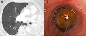 (A) Chest computed tomography showing endobronchial tumor in the LMB. (B) Flexible bronchoscopy showing a smooth, rounded, ochre-colored endobronchial lesion, 3.5 cm from the main carina, completely occluding the LMB.