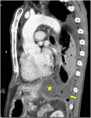 CT oblique sagittal reconstruction: abdominal fluid collection in an anterior site (star) communicating with left pleural effusion (arrow) in a posterior site.