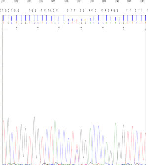 The TGG > CGG mutation at codon 37 in the 2nd exon of the β gene in an allele that determines the replacement of amino acid tryptophan by arginine at position 3 of the C helix of the chain encoded by the mutated allele.