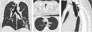 Chest computed tomography showing dilated trachea (large arrows), bronchiectasis (arrowheads); tracheal diverticula (thin arrows).