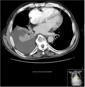 Computed tomography showing right pleural effusion associated with loss of volume.
