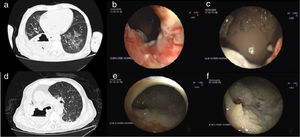 Lung abscesses.