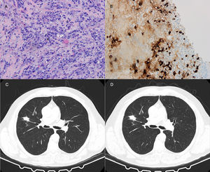 Histological and radiological results from case 1: (A′) hematoxylin and eosin stain, (B′) immunohistochemistry for IgG4-positive plasma cells, (C′) CT images at the time of diagnosis, and (D′) CT images after 2 months of therapy with poor compliance.