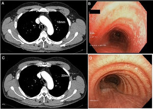 (A) Cross-sectional chest CT slice showing tracheal thickening, including measurement of the tracheal diameter. (B) Pre-treatment bronchoscopy showing lesions in the tracheal wall. (C) Cross-sectional CT slice following treatment with inhaled corticosteroids. (D) Bronchoscopy with no lesions after treatment, including measurement of the tracheal diameter.