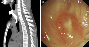 Chest computed tomography (A) and bronchoscopic findings (B) of case 1.