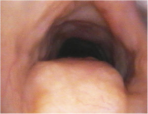 Tracheal amyloidosis.