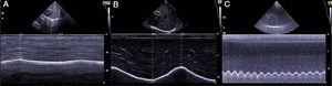 Diaphragmatic dome in 2D and M modes and anatomical measurements of dome movement in A) movement in tidal volume, B) movement in vital capacity, and C) sniff maneuvers.