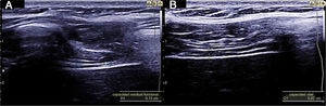 Diaphragm in zone of apposition and measurement of thickness, 2A) functional residual capacity, 2B) vital capacity.