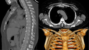 Lytic lesion of the sternum due to tuberculosis.