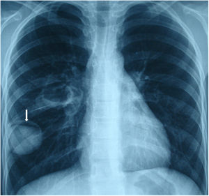 (A) Computed tomography showing an intrabronchial lesion extending from the right main bronchus to the lower bronchus (arrows). (B) Bronchoscopic examination showing a protruding lesion with an irregular surface and necrosis, detected in the endobronchial region of the right main bronchus.