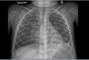 Chest radiograph.