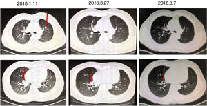 The results of the patients with multiple CT examinations.