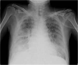 Anteroposterior chest X-ray. Bilateral pleural effusion, greater in the right hemithorax, extending into the fissure. Bilateral micronodular involvement. Ill-defined bibasal opacities in lower lung fields, predominantly in the right side.