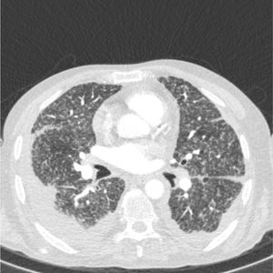 High resolution CT scan of the chest. After ruling out infectious etiologies, the findings were determined to be consistent with Crohn’s disease.