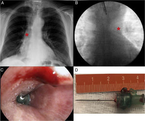 (A) Radiopaque structure embedded in the bronchus intermedius. (B) Foreign body in the left main bronchus visible under fluoroscopy. (C) Endoscopic view of foreign body. (D) Intramuscular needle 2.5cm in length.
