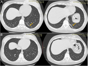 A. Chest CT scan at the time of diagnosis. B. Follow-up chest CT scan after completing the antibiotic treatment.