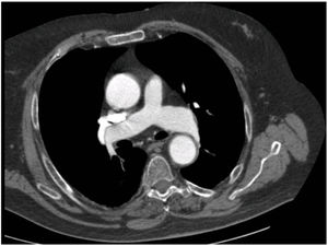 Axial slice with intravenous contrast. Greater contrast enhancement can be observed in the systemic circulation compared to the pulmonary arteries, with presence of contrast in the superior vena cava. Dilation of the ascending aorta can also be observed.