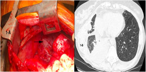 (A) Identification of a chylous fistula in the surgical procedure. (B) CT scan showing the chylothorax refractory to medical and dietary treatment.