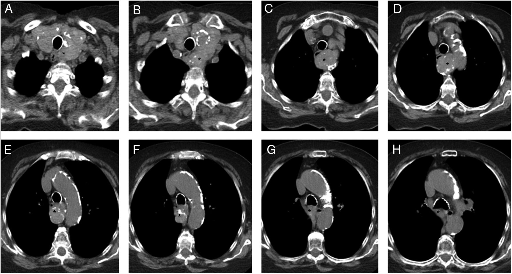 Sunsternal Substernal Goiter with Carinal Involvement Presenting as Mediastinal ...