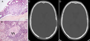 (A) An epithelioid granuloma is observable next to a bone trabecula of the iliac crest, amidst the hematopoietic medullary tissue. (B) A multinucleated giant cell is shown (granuloma) in the tonsil tissue, with two dense concretions suggestive of Schaumann bodies within its cytoplasm. (C) Lytic lesions of the skull before treatment. (D) Total regression of the lytic lesions after treatment with Infliximab.