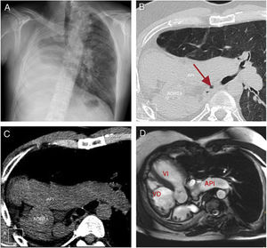 (A) Chest X-ray, posteroanterior projection, showing mediastinal and left lung shift toward the right hemithorax caused by absence of the right lung (pulmonary agenesis). (B) Tomographic axial slice showing lung parenchyma view. The arrow indicates the rudimentary right main bronchus terminating in the pleural sac. (C) Tomographic axial slice without intravenous contrast showing the shift of vascular structures toward the right hemithorax, and absence of right pulmonary artery. API: Left pulmonary artery. (D) Cine-MR b-FFE oblique axial slice. Dextrocardia, dextro-apex and complete absence of right lung parenchyma are observed. VD: right ventricle; VI: left ventricle.