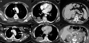 Example of hyperprogression in a 73-year-old patient with progressive non-small cell lung cancer who started second-line immunotherapy (pembrolizumab). The top row (A) shows the baseline CT scan (pre-immunotherapy) while the bottom row (B) shows the CT scan obtained 8 weeks after the start of treatment. (A) Baseline axial CT images (pre-immunotherapy) of upper chest, lower chest, and abdomen (left to right, respectively) showing primary lung tumor (black arrow), bilateral supradrenal metastases (asterisks). (B) Axial CT images of upper chest, lower chest and abdomen 8 weeks after starting treatment (left to right, respectively) showing marked progression of known tumor lesions (black arrow and white asterisks), and the appearance of multiple masses in soft tissues and left axilla (white arrows). The patient died 3 weeks later.