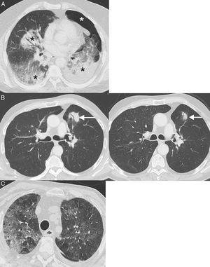 Examples of pneumonitis (lung toxicity). (A) A 64-year-old patient with metastatic lung cancer receiving immunotherapy (nivolumab) in whom the appearance of bilateral peribronchial consolidations (black asterisks) was observed on CT. In this case, we decided to perform a core needle lung biopsy of a dominant consolidation in the left lower lobe, which showed foci of organizing pneumonia and absence of tumor cells; the biopsy was complicated by left pneumothorax (white asterisk). (B) A 68-year-old patient with locally advanced lung cancer receiving adjuvant immunotherapy (nivolumab); the left CT image shows the appearance of a lesion (arrow) with air bronchogram in the left lung. In this case, we decided to administer empirical treatment with systemic corticosteroids. A repeat chest CT at 4 weeks (right) confirmed partial resolution of pulmonary opacity (arrow). The radiological pattern suggested organizing pneumonia. (C) A 76-year-old patient with metastatic lung cancer receiving immunotherapy (pembrolizumab) who presented in the emergency department with dyspnea. Chest CT showed extensive bilateral ground glass attenuation opacities (pattern of non-specific interstitial pneumonitis). The patient improved after discontinuation of immunotherapy and administration of systemic corticoids.
