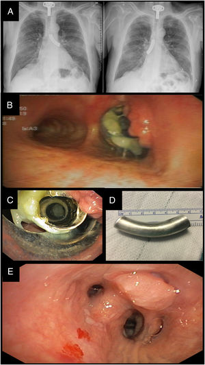 (A) Chest X-rays. Radiopaque material located in the left main bronchus and subsequently in the right main bronchus. (B) Video-assisted bronchoscopy. Granuloma in the proximal area of the cannula tube. Mucosal plug at the proximal end partially obstructing the lumen. (C) Rigid bronchoscopy. Removing the tube from the cannula pushing aside the granuloma with the bronchoscope tip to prevent bleeding. (D) Photography. Silver cannula tube 6cm in length. (E) Video-assisted bronchoscopy. Distal granuloma that trapped the cannula tube in the lung base.