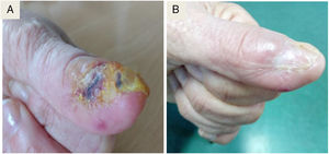 Nail before (A) and after 6 months (B) of anti-tuberculosis treatment.