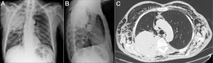 (A and B) Plain chest X-ray in PA and lateral projections. Voluminous mass in right upper lobe, and minor cervical subcutaneous emphysema. (C) Chest CT (axial slice, mediastinum window). Resorption of posterior costal arches at the site of the mass, pneumomediastinum and massive subcutaneous emphysema.