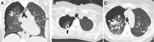 Chest computed tomography: (A) coronal slice; (B and C) transversal slice. Peripheral cavitary pulmonary nodules (arrows) in the right and left upper lobe and right pneumothorax.