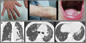 (A) Mucocutaneous manifestations: nail dystrophy, reticular pigmentation, and oral leukoplakia. (B) High-resolution computed axial tomography.