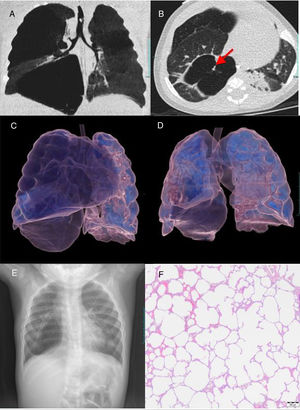 (A and B) Coronal (A), axial (B) CT images show areas of regional cystic hyper radiolucent and hyper expansion that involve right upper and lower pulmonary lobes and mediastinal displacement to the left. Note solid linear structure in the air filled cyst (arrow in B). (C) CT 3D volume rendering images before surgery. Hyper radiolucent cystic structures occupy right upper and lower lobes with hyper expansion and herniation of the right lung toward the left. (D) CT 3D volume rendering images after surgery. Right lung volume reduction and persistence of lower lobe cyst structure with minor hyper expansion. (E) Chest radiograph after surgery demonstrates right lung volume and mediastinal shift reduction with persistence of bullae in the right lower lobe. (F) Histologic examination (magnification ×40) of the upper right lobe shows severe evolved emphysema areas with marked alveolar hyper expansion due to air trapping, compressed parenchyma and generalized loss of interstitial connective tissue.