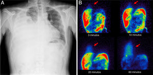 a) Posteroanterior chest X-ray showing increased radiation density in right hemithorax consistent with massive pleural effusion; b) peritoneal scintigraphy showing rapid diffusion of the radiotracer from the peritoneal cavity to the right hemitorax, which is most obvious in static images acquired in posterior projection after 60 min. This image is consistent with pleuroperitoneal fistula.