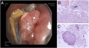 (A) Endoscopic image showing the occupation of the LMB by granulomatous tissue. Around the lesion are the typical yellowish sulfur granules, highly characteristic of the genus Actinomyces. (B and C) Histopathological view by optical microscopy: (B) endobronchial tissue stained with hematoxylin-eosin and sulfur granule indicated by an arrow; (C) this granule can be observed at higher magnifications.