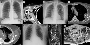 (A) Posteroanterior chest X-ray showing no pneumonic consolidation. (B) Chest CT axial image showing a collection in the thickness of the right pectoralis major muscle (arrows). (C) Anteroposterior chest X-ray identifying a new extraparenchymal lesion. (D) Chest CT axial image showing a focal lytic lesion in the left fourth costal arch (arrow) surrounded by an extrapleural fluid collection (asterisk). (E) Chest CT axial image (maximum intensity projection) showing the percutaneous drainage procedure of the left hemithorax collection. (F) Follow-up anteroposterior chest X-ray showing radiological improvement of the collection. (G) MRI sagittal image (inversion-recovery sequence with fat suppression) identifying typical signs of acute spondylodiscitis: increased signal intensity in the L5-S1 intervertebral disc (arrow) and altered signal of the vertebral endplates adjacent to the disc (asterisks). (H) MRI axial image (T1-weighted sequence after intravenous gadolinium administration) showing a ring-enhancing collection in the thickness of the left pyramidal muscle (arrow).