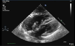 Transthoracic echocardiogram showing an image consistent with very long thrombi in both the left and right atrium that appeared to cross continuously through a patent foramen ovale, suggestive of thrombus in transit.