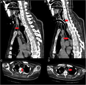 CT images of the chest and neck showing tracheal dilation in sagittal and axial slices (A and C) and tracheoesophageal fistula (B and D); in addition, right pulmonary infiltrate due to repeated bronchoaspiration can be seen on images C and D.