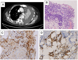 A. Chest CT image showing left pleural effusion with pulmonary atelectasis. B. Pleural biopsy (hematoxylin-eosin) showing fibrohemorrhagic pleuritis with severe mesothelial hyperplasia and dense plasmocellular infiltrate. C. Pleural biopsy (immunohistochemical staining for IgG) showing abundant IgG-type plasmocellular infiltrate. D. Pleural biopsy (immunohistochemical staining for IgG4) showing marked increase in IgG4-producing plasma cells with areas of > 50 cells per high-power field and an IgG4/IgG ratio of 49%.