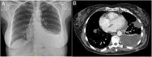 A) Chest X-ray showing left pleural effusion. B) Computed axial tomography (mediastinal window) showing free and organizing left pleural effusion.