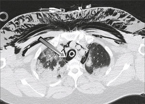 Case 1. Chest computed tomography. Rupture is observed in the pars membranacea of the right membranous-cartilaginous junction in the distal third of the trachea, indicated by an arrow.
