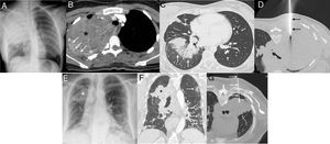 A–D) A 19-year-old patient with dyspnea, chest pain, cough, and fever. A) Posteroanterior chest X-ray showing a large mass in the right hemitorax and partial destruction of the right third costal arch. B) Axial CT image of the chest (mediastinum window) confirming a large heterogeneous mass in the right hemitorax (asterisk) with destruction of the right third costal arch (arrows). C) Axial CT image of chest (lung window) showing peri-bronchial ground glass opacities of infectious appearance (arrows). D) Axial CT image of chest (patient in prone position) during biopsy procedure (arrows mark biopsy needle). E–G) A 73-year-old patient with fever, cough, and dyspnea. E) A posteroanterior chest X-ray showing a mass in left upper hemitorax (asterisk) and bilateral opacities of an infectious appearance. F) Chest CT coronal image (lung window) showing lung mass (asterisk) and bilateral pneumonic opacities (arrows). D) Axial CT image of chest (patient in prone position) during biopsy procedure (arrows mark biopsy needle).