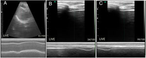 (A) Diaphragmatic dome in 2D and anatomical M modes with convex transducer showing displacement of the dome in vital capacity. (B) Diaphragm in zone of apposition with linear transducer and measurement of thickness in maximum expiration. (C) Diaphragm in zone of apposition with linear transducer and measurement of thickness in minimum expiration. (B and C) For calculation of preoperative shortening fraction.