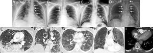 (A) Posteroanterior chest X-ray in a 60-year-old woman admitted with bilateral SARS-CoV-2 pneumonia showing incidental pneumomediastinum (white arrows). Note the spread of gas to the soft tissue of the neck (black arrow). (B) Posteroanterior chest X-ray in a 62-year-old man admitted with bilateral SARS-CoV-2 pneumonia, who presented chest pain and dyspnea. Right paratracheal pneumomediastinum (arrows) is seen on the X-ray. (C) Posteroanterior chest X-ray in a 58-year-old man with bilateral SARS-CoV-2 pneumonia, who had an episode of chest pain and hypotension. On the X-ray, pneumomediastinum with pneumopericardium (arrow) and gas is seen in the soft tissue of the right supraclavicular region (asterisks). (D) Topogram (corresponding to a chest CT scan) of the only CT-diagnosed pneumomediastinum in a 64-year-old woman with bilateral SARS-CoV-2 pneumonia, who presented with chest pain and dyspnea. The topogram shows a large pneumomediastinum extending to the soft tissue of the neck (arrows). (E) Axial CT image of the chest (lung window) of the patient in image D confirming the presence of ectopic gas surrounding the main bronchi (black arrows) and dissecting the pericardium (white arrows). (F) Coronal chest CT image (lung window) of patient in image D in which air can be seen dissecting both main bronchi (short arrows) and right paratracheal fatty tissue (long arrows). (G) Axial chest CT image (lung window) of patient in image B confirming the presence of gas dissecting the pericardium (arrows). H) Coronal chest CT image (lung window) of the patient in image B showing gas dissecting the pericardium (arrows). (I) Axial CT image of the chest (mediastinum window) of the patient in image B, identifying a defect in a subsegmental artery in the right lower lobe (long arrow). Note the presence of gas in pericardial fat (short arrow).