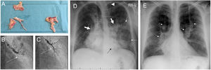 Images from patient 3. A. Material removed from the pulmonary vasculature by pulmonary endarterectomy. B. Pulmonary angiography showing occlusion (arrow) of the anterior segmental artery for the left superior lobe prior to percutaneous treatment of this region. C. The anterior segmental artery for the left superior lobe is recanalized after balloon pulmonary angioplasty (arrow). D. Chest X-ray on admission showing Ill-defined consolidations in medium and inferior left pulmonary fields (thin arrows). Note the dilation of the main pulmonary arteries (thick arrows) and the sternotomy wires. Interestingly, the patient carries a ventriculoperitoneal shunt (arrowhead). E. Chest X-ray at discharge. Complete clearing of lung opacities can be seen. Dilation of both pulmonary arteries is better recognized (arrows).