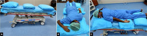 (A) The preferred bed position is reverse trendelenberg (at least 30°) along with three to four pillows. (B) The position of the patient during proning as viewed from cranial end. (C) The patient position as viewed from right side; head, pelvis, and legs are supported with pillows.