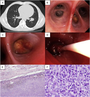 (A) Chest CT (axial plan (AP)): a 29mm homogeneous nodular lesion in the left lower lobe; (B) Endobronchial view of left lower lobe, with a mass blocking the lateral segmental bronchus (LB9); (C) A closer view of the mass, which was yellow, with a smooth surface and a long implantation base, containing multiple superficial vessels, almost completely blocking the entrance orifice of LB9; (D) The balloon catheter tamponade was inserted at the left common basal trunk; (E) Microscopic examination of the surgical sample revealed tumour free margins and (F) formation of aggregates with plenty of plasma cells and cells having an oval to fusiform appearance.